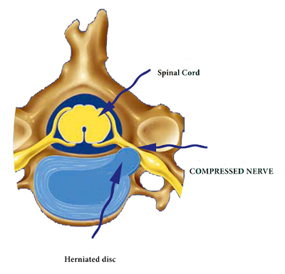 Herniated_disc2